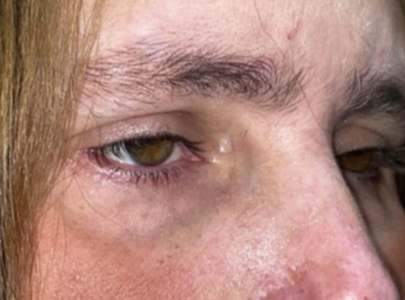 Ptosis Repair