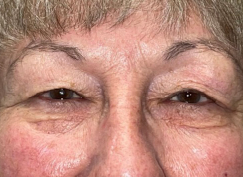 Eyelid Lift