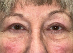 Eyelid Lift