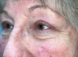 Eyelid Lift