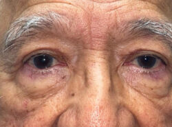 Eyelid Lift